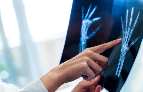 生長板位置與閉合年齡全攻略